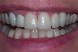 Patient’s teeth after having porcelain veneers to change the shape of the teeth