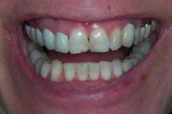 Patient’s teeth before having porcelain veneers