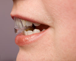 Patient wearing a nightguard used to alleviate jaw stiffness and headaches caused by grinding the teeth