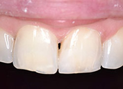 After: Patient's mouth with plastic bonded to the tooth