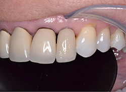 After: Patient's mouth with an implant placed with a crown over it to fill the space