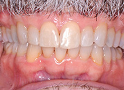 After: (Frontal view) Patient's mouth after Invisalign brought teeth even with other teeth