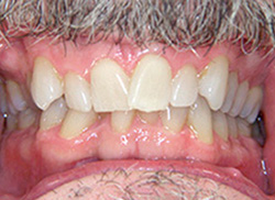 Before: Patient's mouth with severe crowding of teeth