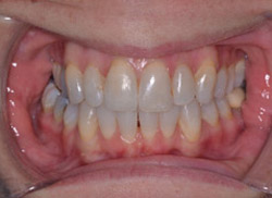 After: Patient's mouth after Invisalign brought the tooth into the arch