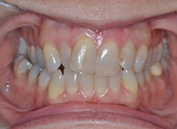 Before: Patient's mouth with tooth blocked out of arch
