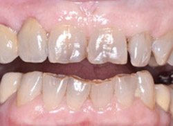 After: Patient's mouth with a crown placed on a tooth next to the empty space and a false tooth placed off the crown