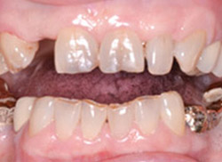 Before: Patient's mouth with space from missing tooth
