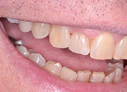 After: Patient's mouth with plastic bonded to fill the space 