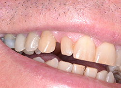 Before: Patient's mouth with too much space between teeth