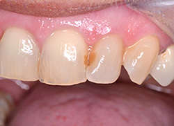Before: Patient's mouth with stained tooth
